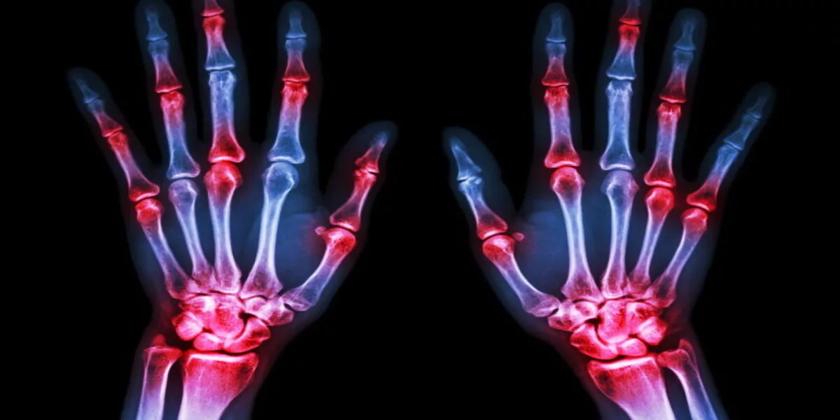 Understanding Arthritis