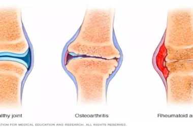 Arthritis