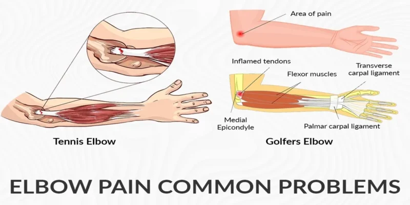 Elbow Pain