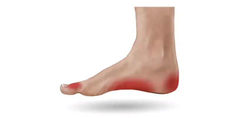 Foot Pain