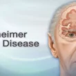 Alzheimer