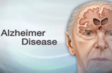 Alzheimer