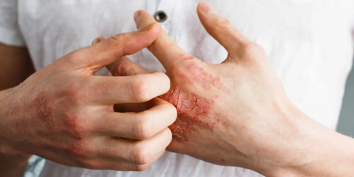 Effective Home Remedies for Eczema Relief