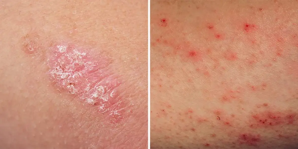 Key Differences Between Eczema and Psoriasis