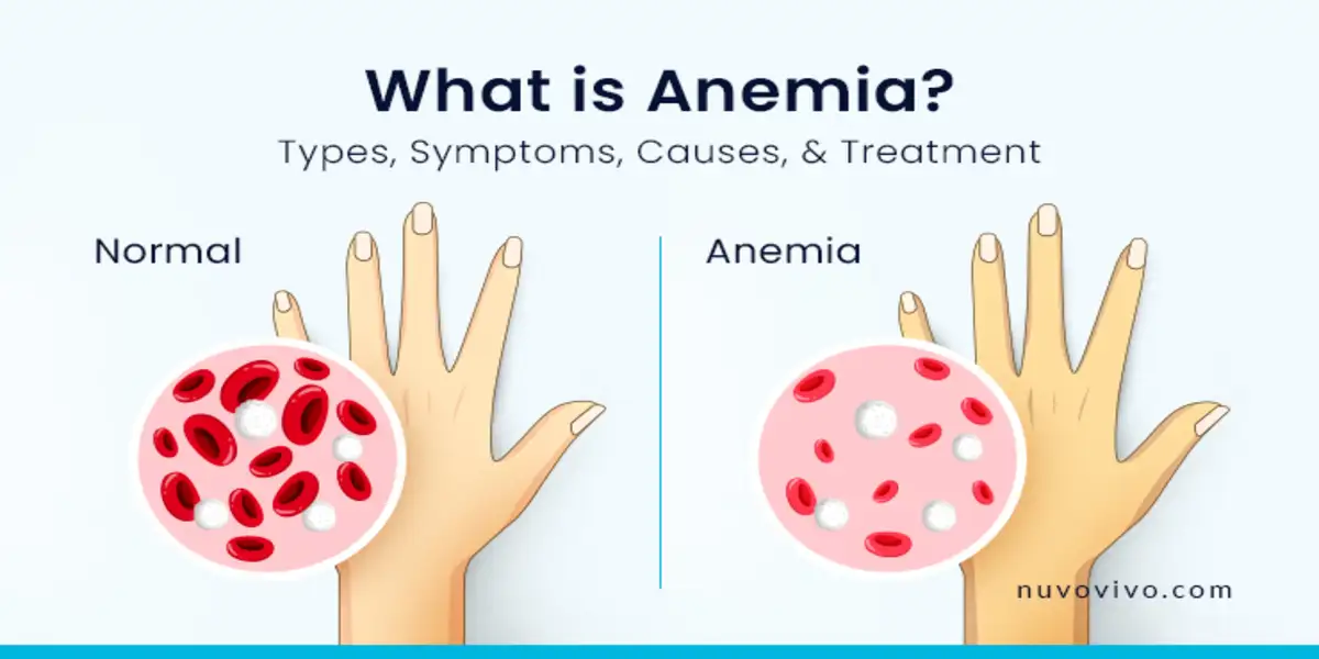 https://takeapk.com/understanding-iron-deficiency-anemia-symptoms-causes-and-treatment-options/