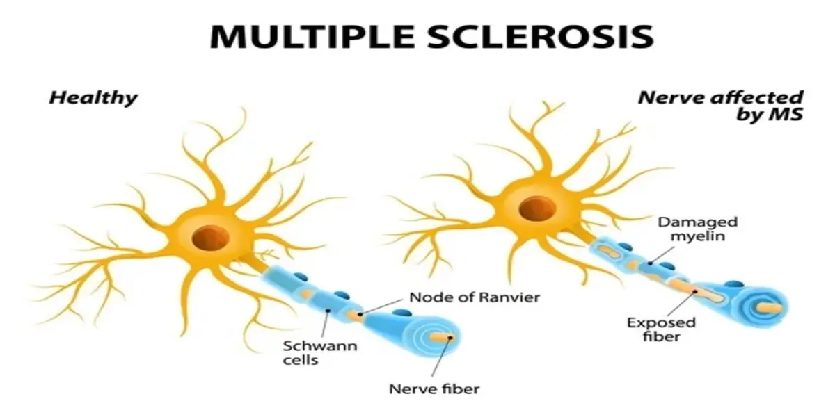 Understanding Multiple Sclerosis: Causes, Risk Factors, and Prevention