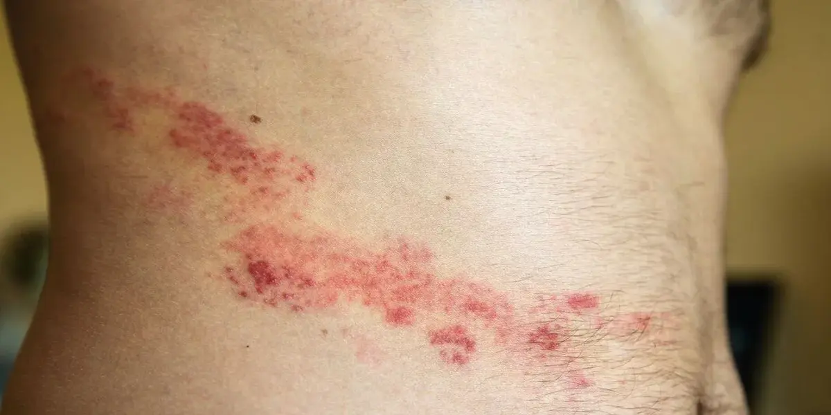 Understanding Shingles: Symptoms, Causes, and Treatments