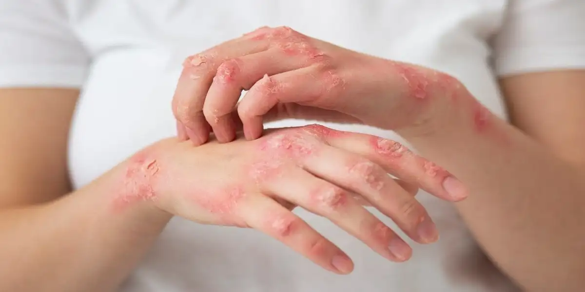 What-Is-Leprosy-Hansens-Disease